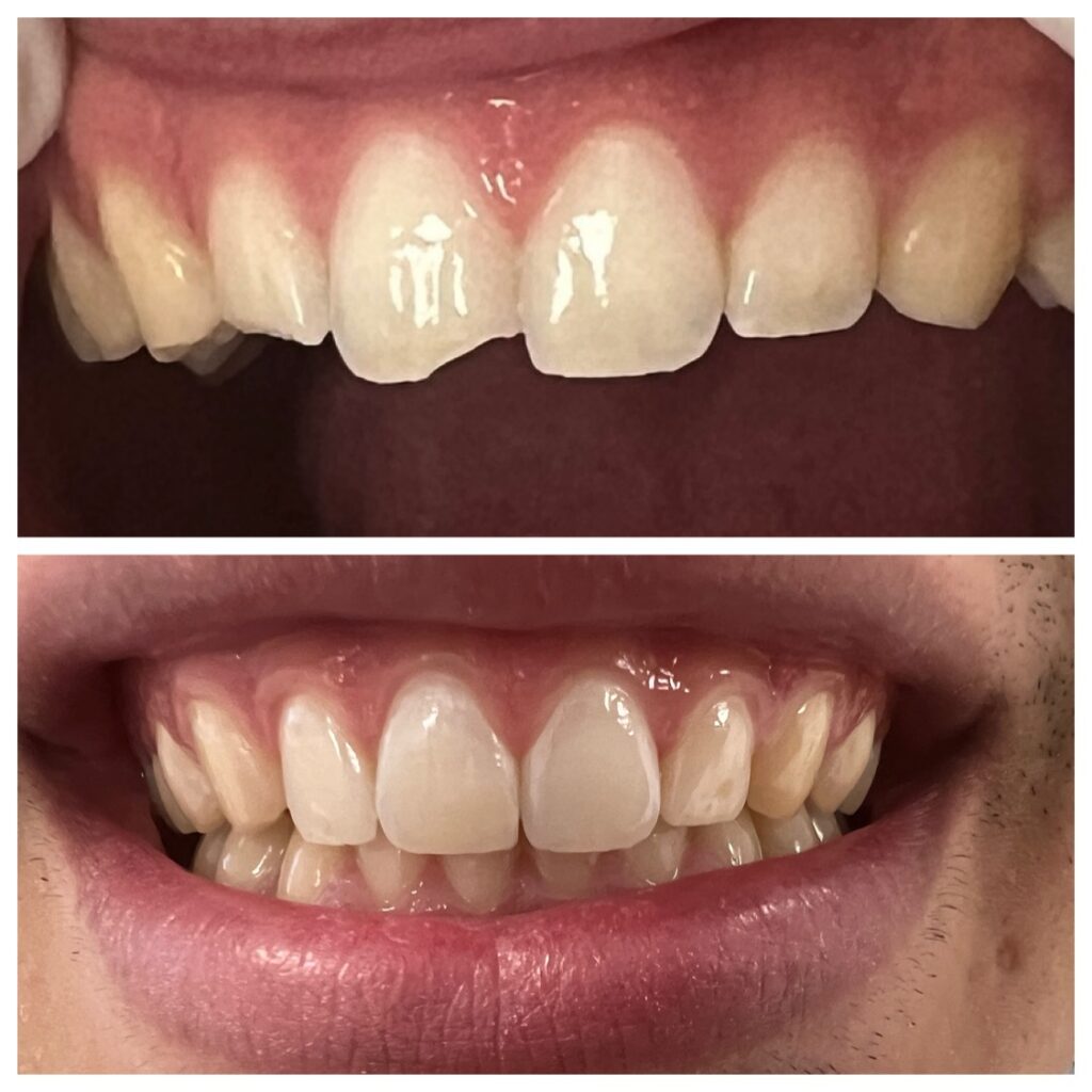 komposit zahnfüllung