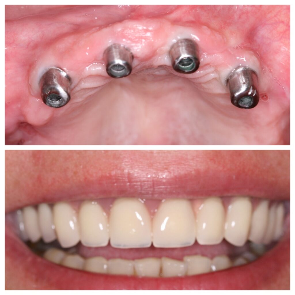 implantatgetragene herausnehmbare prothesejpg