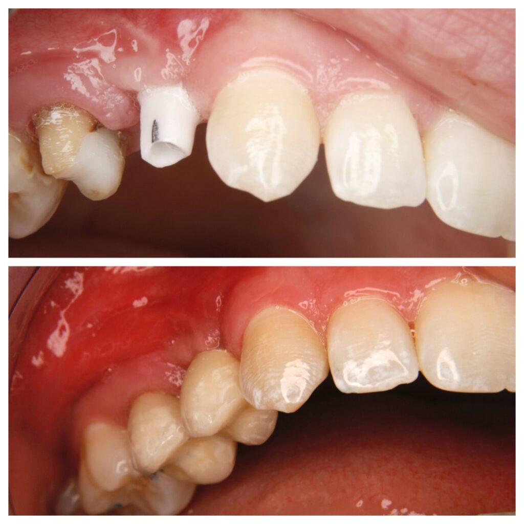 Implantatgetragenen einzelkrone