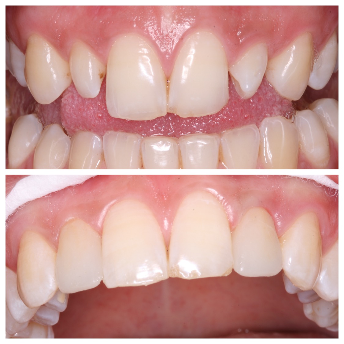 vollkeramische verblendungsschale